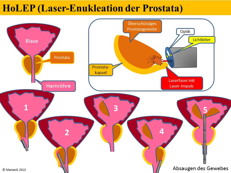 holmium laser enukleation der prostata jeder größe dispozitive pentru prostatită