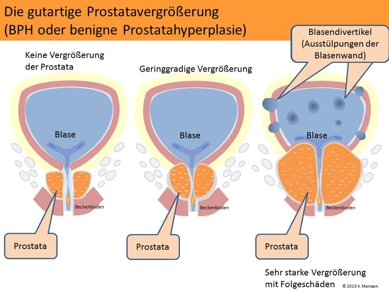 prostata adenom symptome)